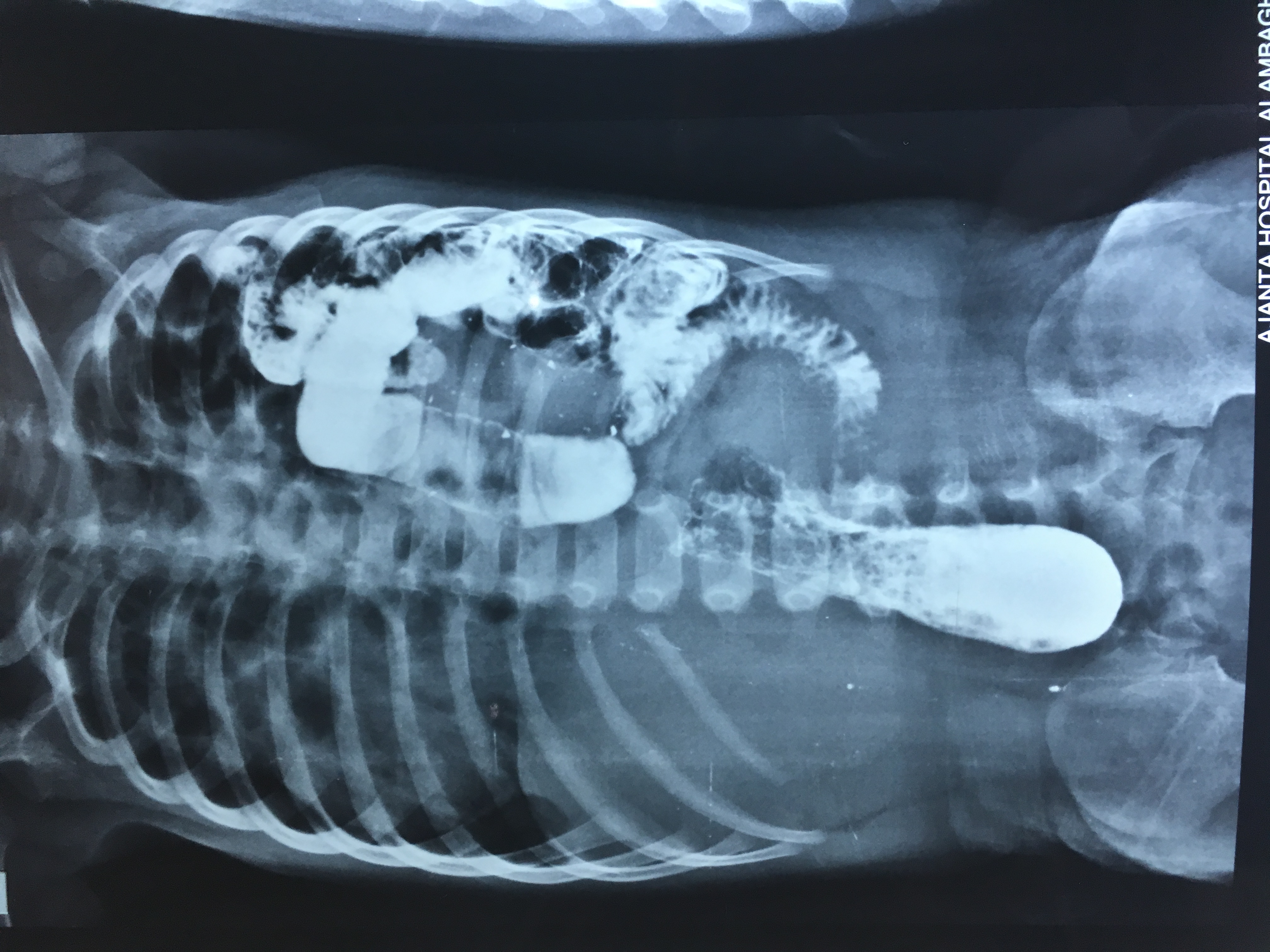 Bronchoscopy Image 2